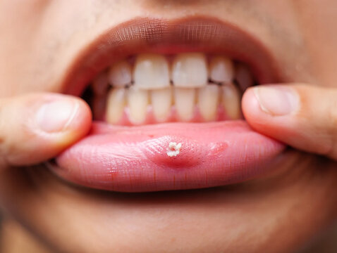 Close up of mouth with canker sore on lower lip lips ulcer