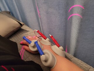 Physical Therapy Treatment Using Electrical Muscle Stimulation Electrodes on a Patient's Hand for Pain Relief