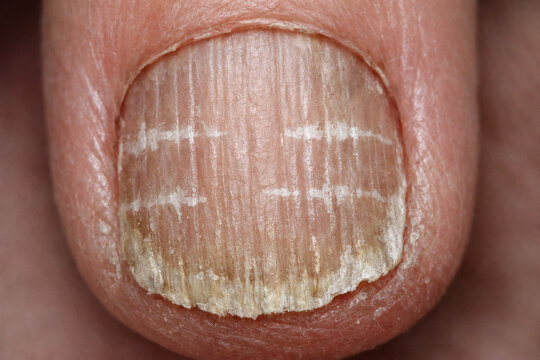 Close-up of a human nail with white lines known as Mees' lines. These lines run horizontally across the nail, indicating potential health issues.