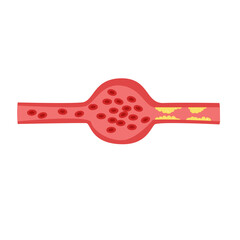Cholesterol Buildup in Blood Vessel concept