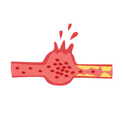 Cholesterol Buildup in Blood Vessel concept