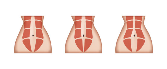 Different stages of diastasis recti showing abdominal muscles separation