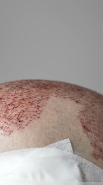 Post Transplants Healing, Scalp Recovery After Graft Procedure, Detailed View Of Scalp Posttransplantation Healing Process, Close Examination Of Healed Scalp With Grafts And Donor Site Detailing