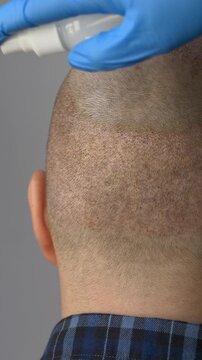 Medical Scalp Care After Procedure, Healing Spray Applied For Skin Recovery, Careful Application Of Healing Mist On Surgical Scalp Area, Closeup Of Head And Healing Skin In Clinical Environment.