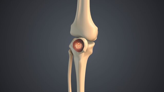 Malignant involvement of the patella