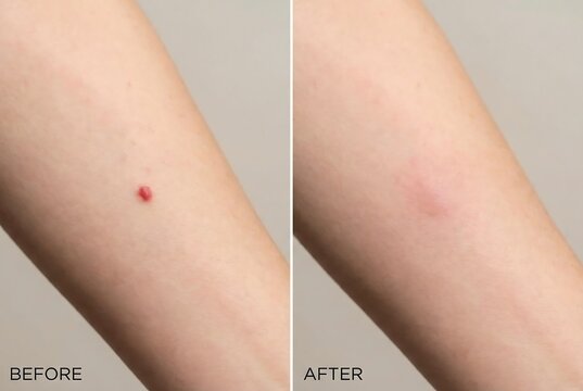 Woman arm with red nevus before and after removal treatment. Medical dermatology concept for skin health and cosmetic procedure.