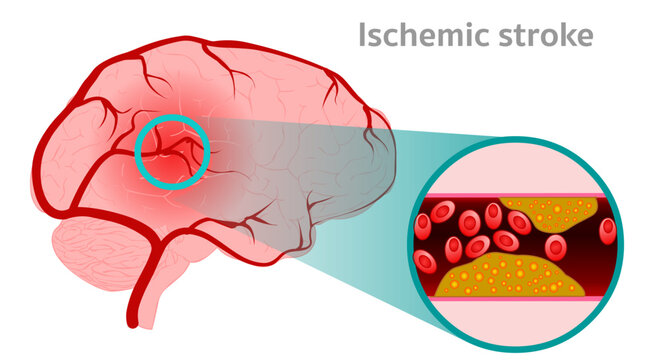 Ischemic strokes happen when a blood clot blocks a blood vessel in your brain. Cross section. Illustration vector