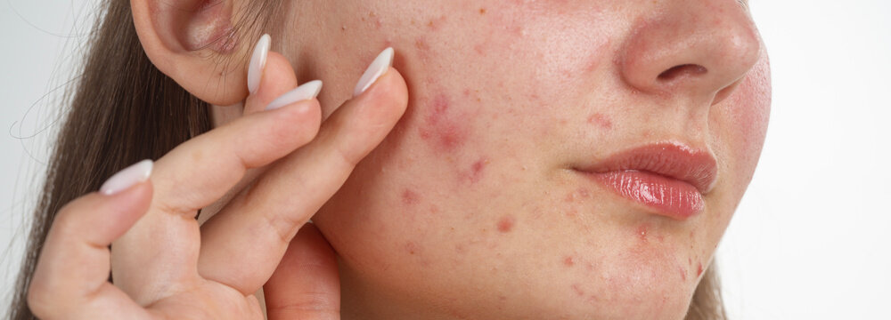 Pimple acne on young woman face close up. Pimple skin macro. Pimple treatment concept. Acne on female skin. Acne pores texture on skin closeup.. Acne pimple detail.