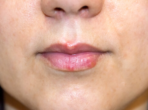 Herpes virus, cold sores on the lips