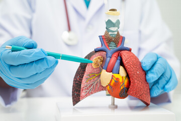 Pneumonia, lung cancer, Asian doctor holding human model.