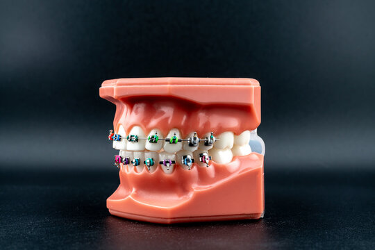 Orthodontic dental model with colorful metal braces on black background