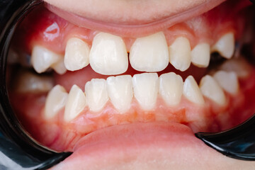 Patient suffering from toothache waiting for dentist in clinic
