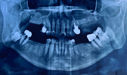image panoramic x-ray of teeth and jaw human