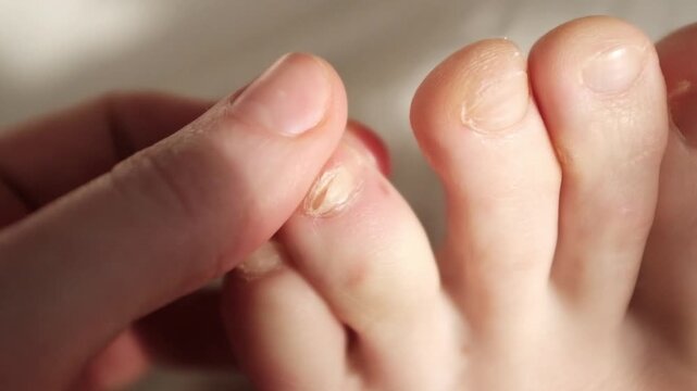 Damaged toenail closeup slow motion video. Onycholysis is a common nail disorder. Causes of onycholysis include trauma, skin disease, and nail infections. Podiatry treatment to follow.
