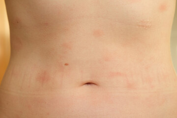 Atopic dermatitis on the abdominal skin of a woman, severe itching on the side. Allergy or urticaria, hives.