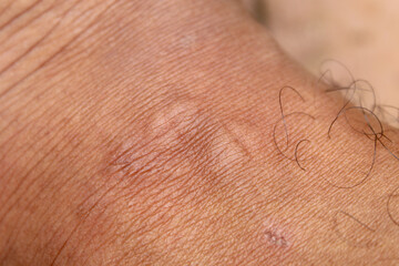 Fototapeta premium Detail of brown skin on men's legs with bumps