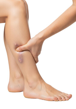 close-up of a woman's lower leg showing swollen varicose veins and muscle tension; a hand massages the affected area for pain relief against a clinical white backdrop. health issue illustration