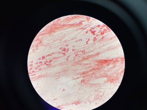 Gram negative diplococci sample pus from penis.