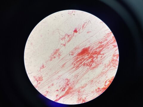 Gram negative diplococci sample pus from penis.