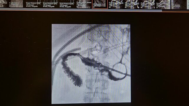 Upper GI dynamic imaging showing duodenal leak near catheter