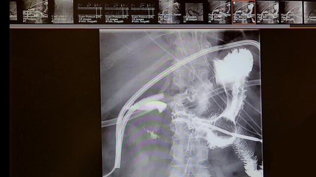 Upper GI dynamic imaging with pulsations due to heartbeat