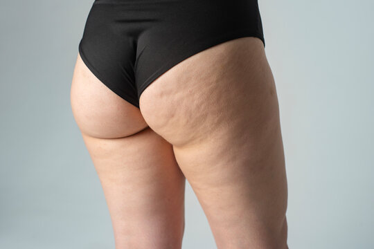 Woman with cellulite. Cellulite thigh fat skin texture. Young woman with cellulite problem. Cellulite and cosmetic concept.