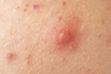 Fototapeta premium Pimple macro closeup on inflamed skin. Pimples closeup detail for dermatology. Pimple macro texture on skin. Skin problem. Acne closeup. Acne oily skin in puberty. Dermatology concept.