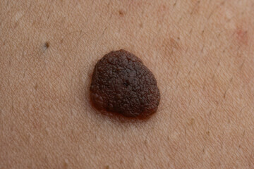Fototapeta premium Moles and pimple,on skin closeup. Moles macro, pimple on skin. Moles texture in pores. Moles macro for dermatology.