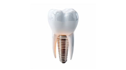 A detailed model of a dental implant showing the artificial crown and screw root