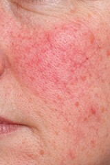 Fototapeta premium Facial redness and broken capillaries (rosacea)