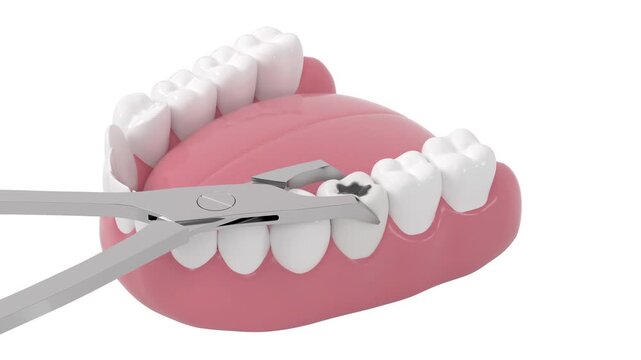 Pull up tooth decay, unhealthy teeth, 3d rendering 4k