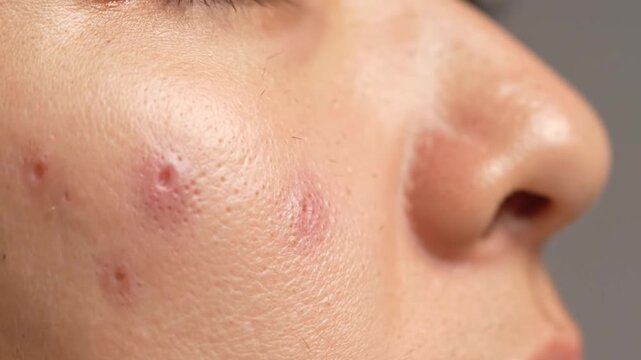 Extreme close-up of human facial skin with visible pores and inflamed blemishes