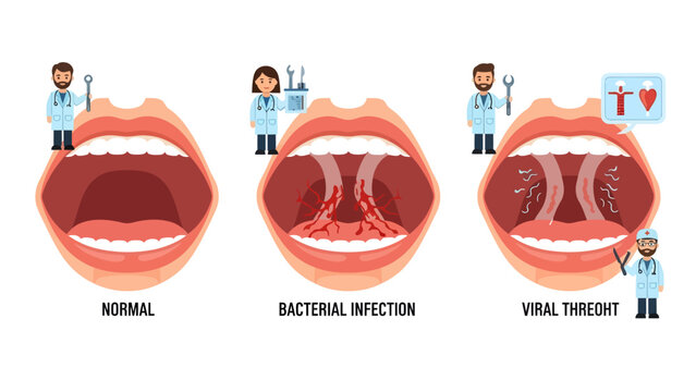 Throat Conditions Normal Infection Viral Threat.