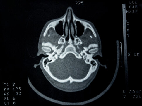 A computed tomography (CT) scan of the human head, specifically an axial view of the paranasal sinuses and skull base