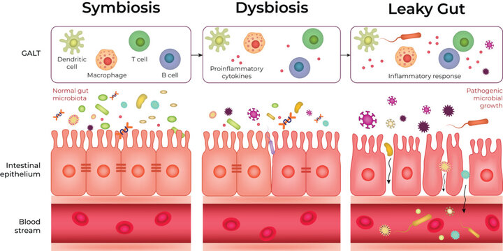 Gut Health Progression Symbiosis Dysbiosis and Leaky Gut Syndrome