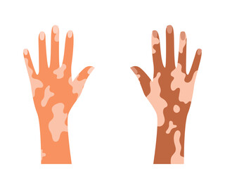 Human Hand Vitiligo, skin disease, self care and self love