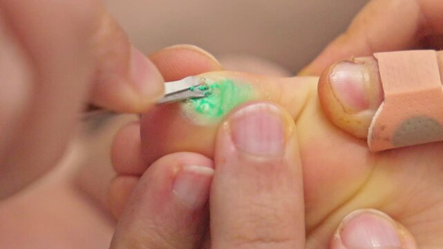 kid foot with plantar warts on toe, adhesive bandage used to soften skin, home care treatment with scissors trimming skin edge. Concept of hygiene, pediatric foot care and minor health issue.