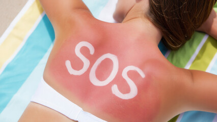 Sunburned back with bold SOS sunscreen message on red skin highlighting dangers of UV exposure and forgotten sun protection during summer beach tanning with visual call for skincare awareness caution
