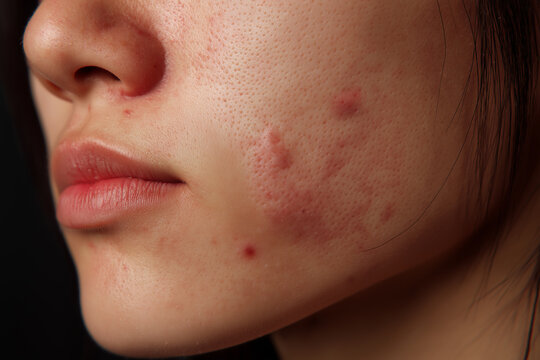 xtreme close-up of young Asian woman's cheek with severe red acne and breakouts, dermatology skin problem concept