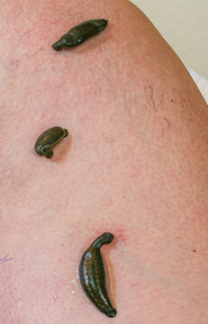 Medicinal leeches performing hirudotherapy treatment on leg skin