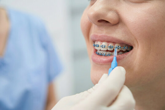 Close-up of woman with dental braces cleaning teeth with interdental brush at orthodontic clinic