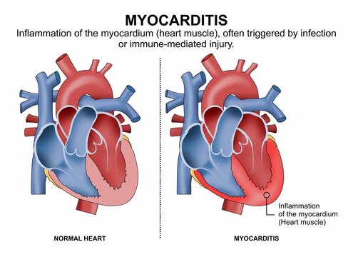 Myocarditis inflammed heart medical flashcard