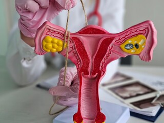 Doctor gynecologist ligates fallopian tubes on example of layout female reproductive system. Contraception concept for unwanted pregnancy