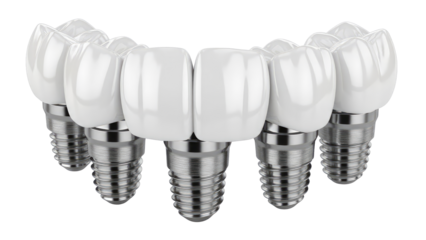Surgical-Dental-Implants-Prosthetic-Teeth-With-Metallic-Screws-and-Crowns-High-Resolution-White-Background.png