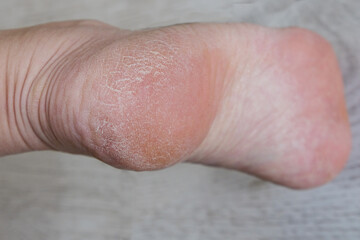 Fototapeta premium Close-up of womans heel with prominent area of callused, dry skin. Concept of foot care and dermatology.