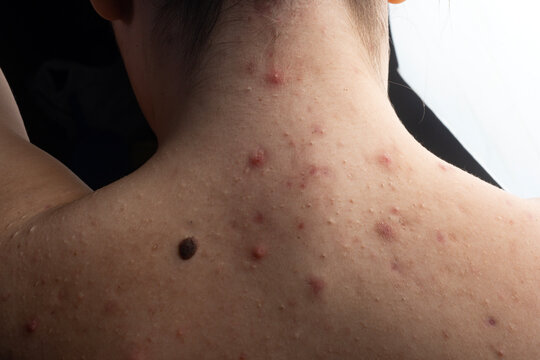 Pimple inflammation on back skin. Pimple acne on neck area. Pimple dermatology issue on shoulders. Pimple treatment concept for skincare. Female acne close up. Acne pores on skin.