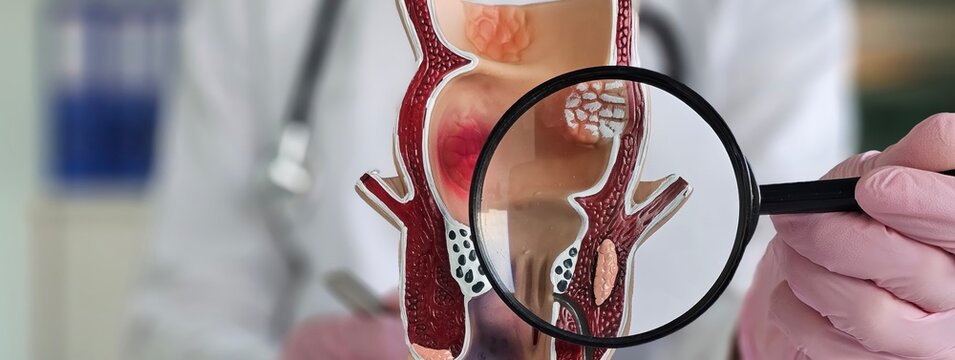 Proctologist holds magnifying glass and anatomical model of rectum with hemorrhoids. Diseases of the rectum signs and diagnosis concept