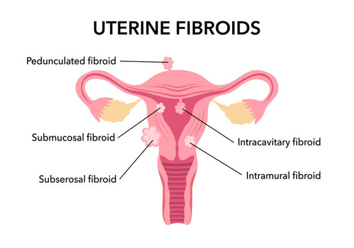Flat vector illustration of uterine fibroids, myoma, uterine leiomyomas on dark blue background. There are cervical canal, cervix, vagina, pedunculated, intracavitary, submucosal, subserosal fibroid.