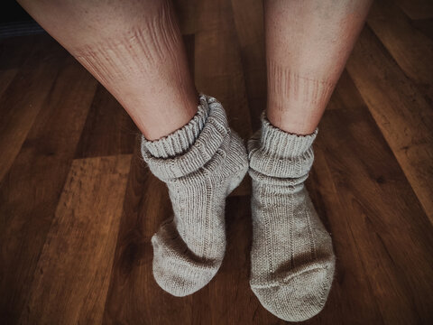 close-up of woman's feet in knitted socks on wooden floor, showing marks from clothing scars or petechiae. Intimacy, feminine essence, problematic sensitive skin, brittle blood vessels. tight clothing