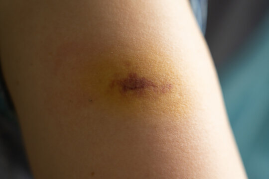 Bruise injury found on the female arm
